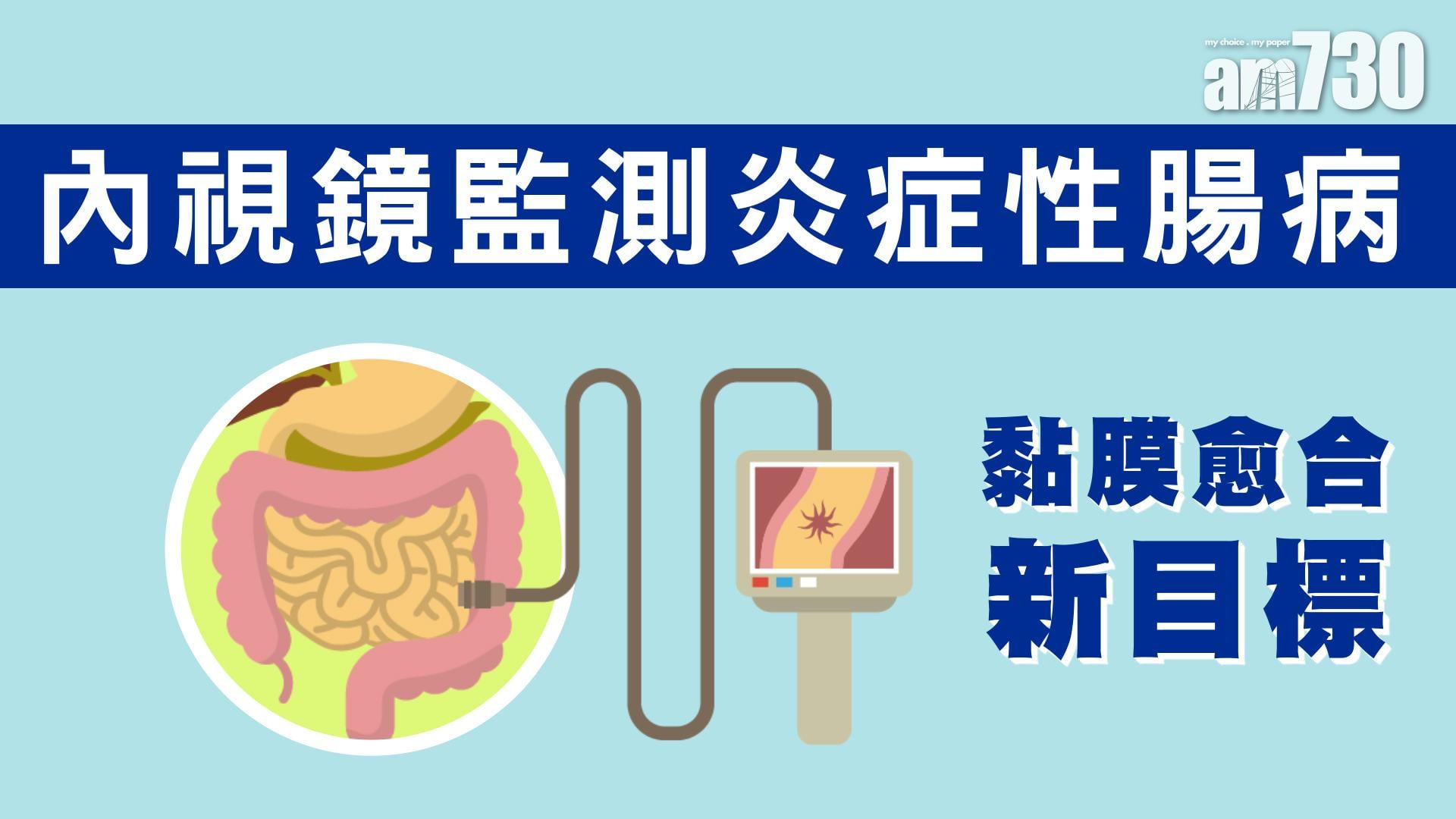 內視鏡監測炎症性腸病 黏膜愈合新目標