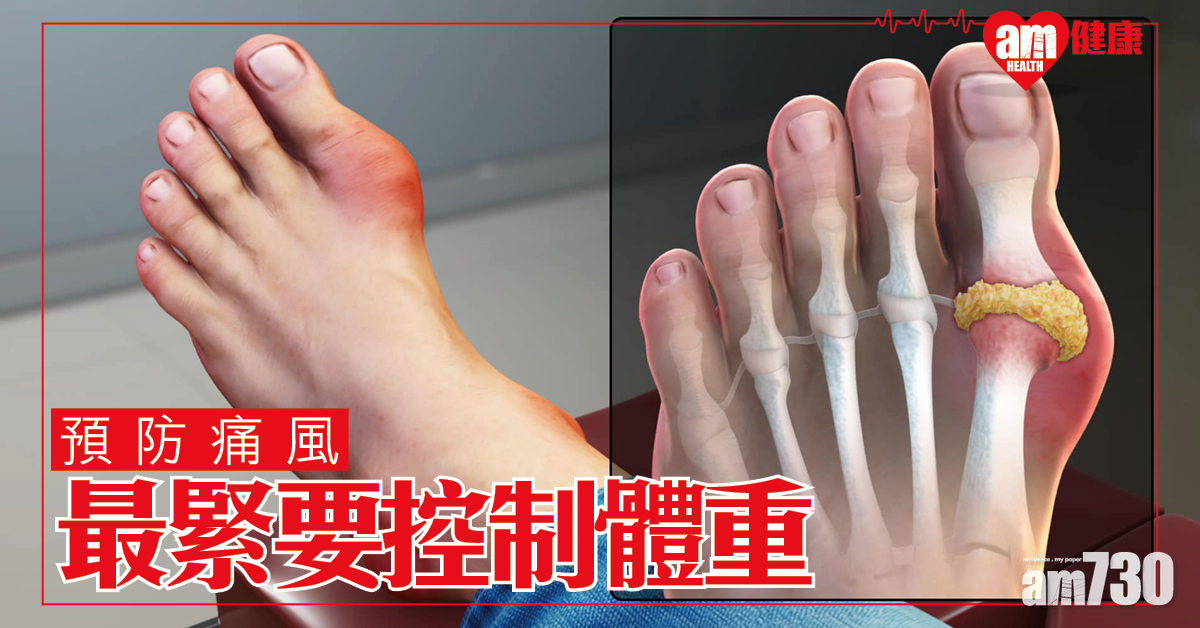 預防痛風 最緊要控制體重