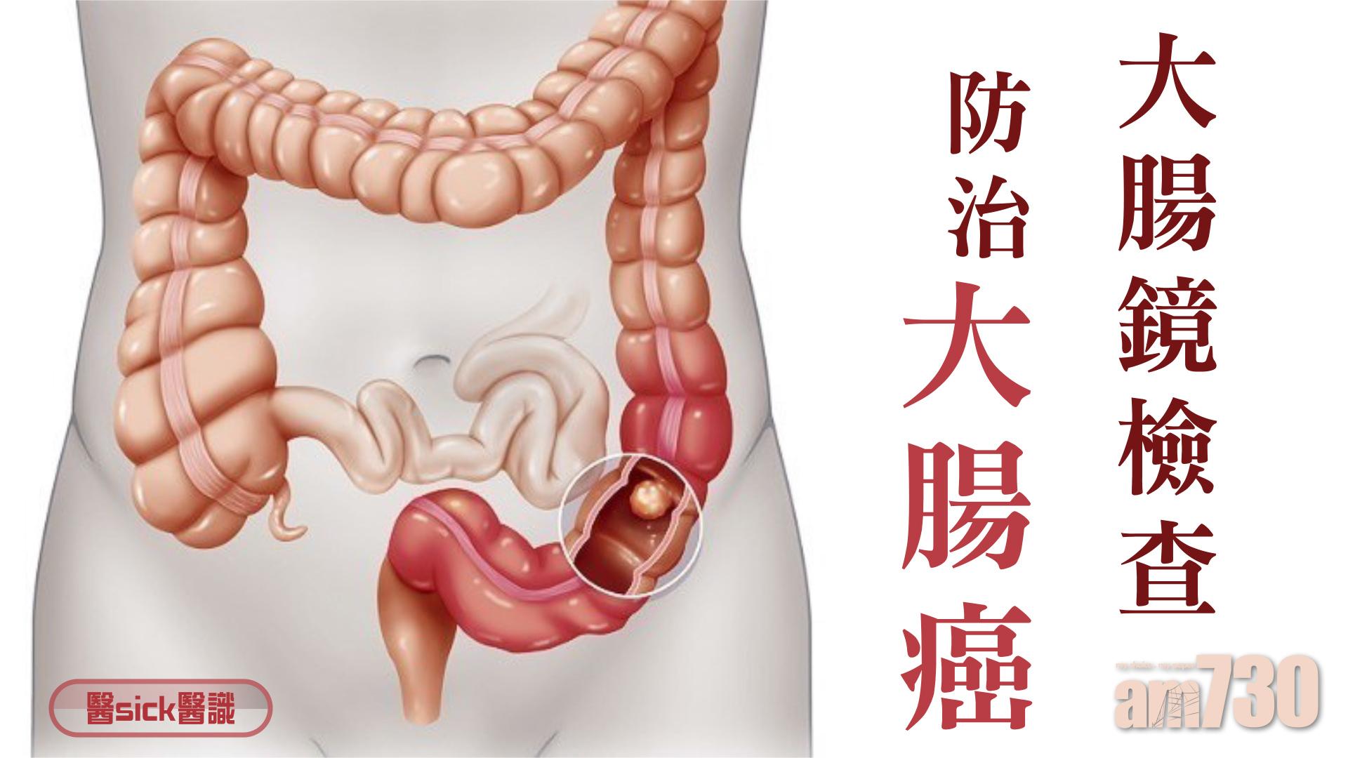大腸鏡檢查 防治大腸癌