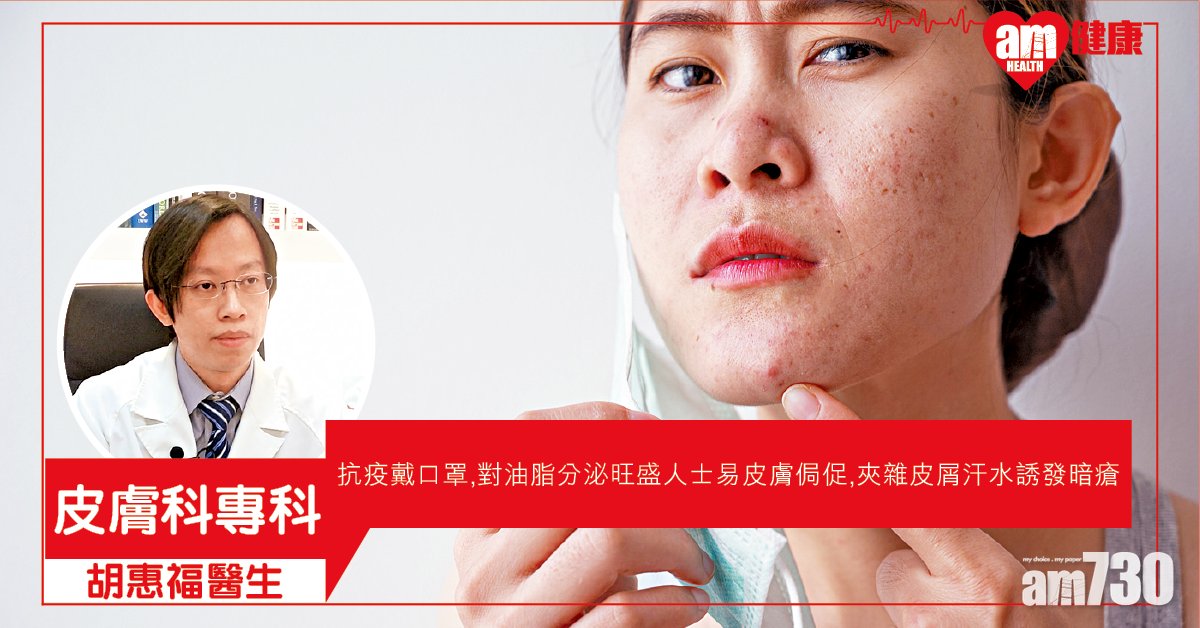 抗疫戴口罩 誘發暗瘡