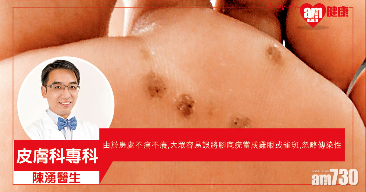 摸電梯也可感染 疣宜及早處理