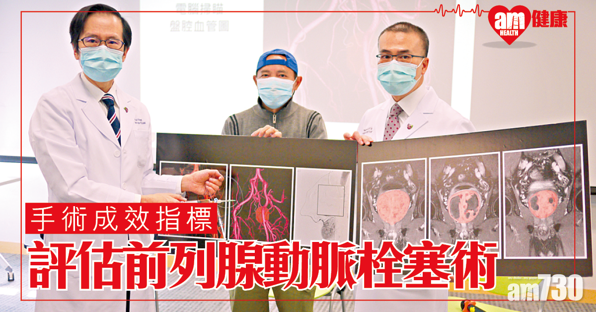 前列腺動脈栓塞術成效可預測 助選合適治療方案