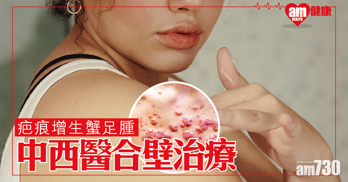 中西醫結合 提升蟹足腫療效