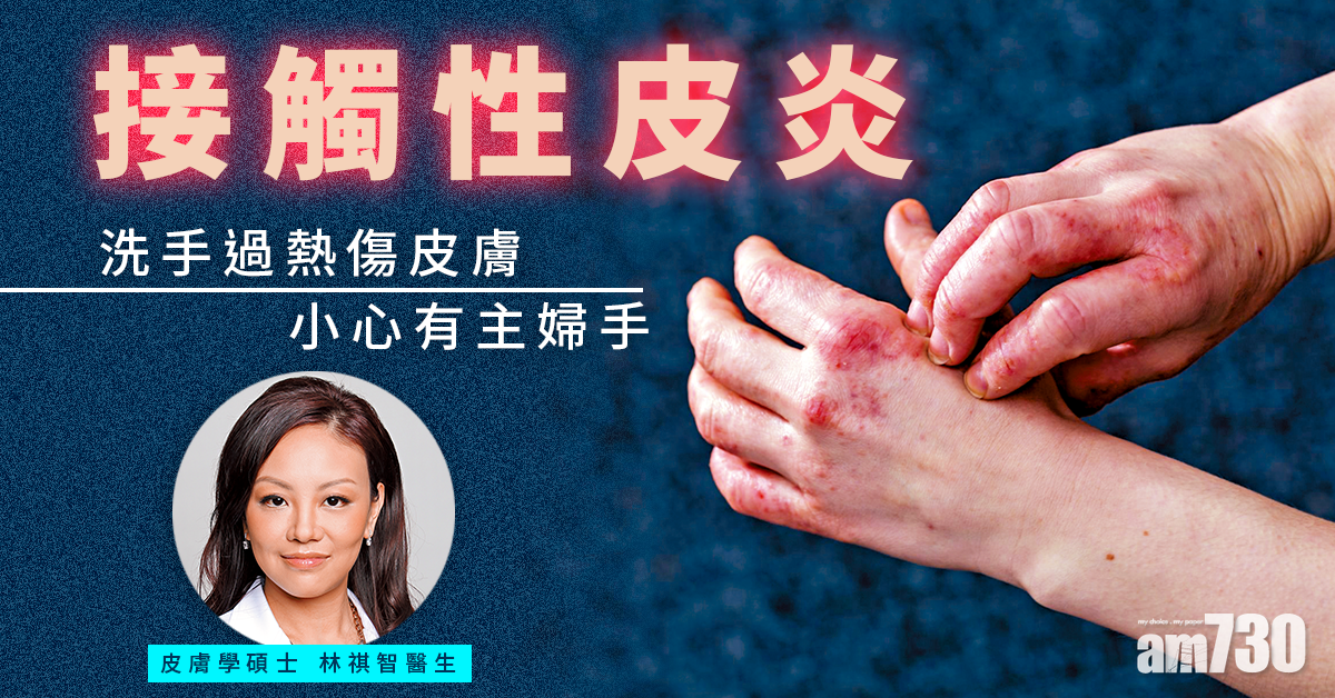 過分洗手 小心主婦手