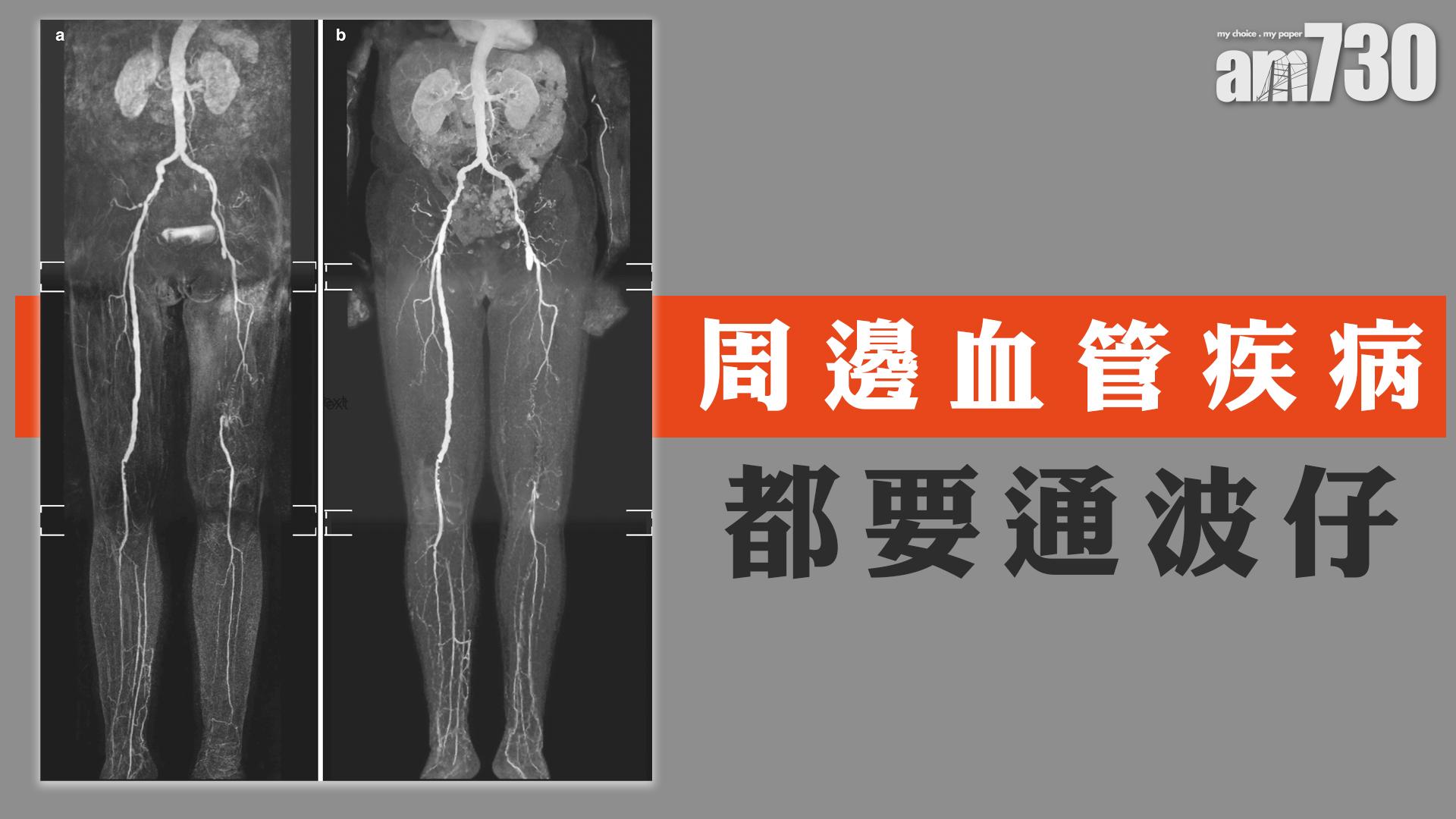 周邊血管疾病 都要通波仔