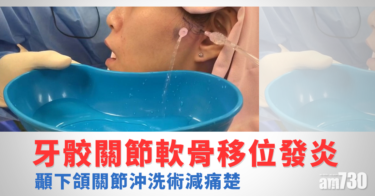 顳下頜關節沖洗術 更有效治療牙骹痛