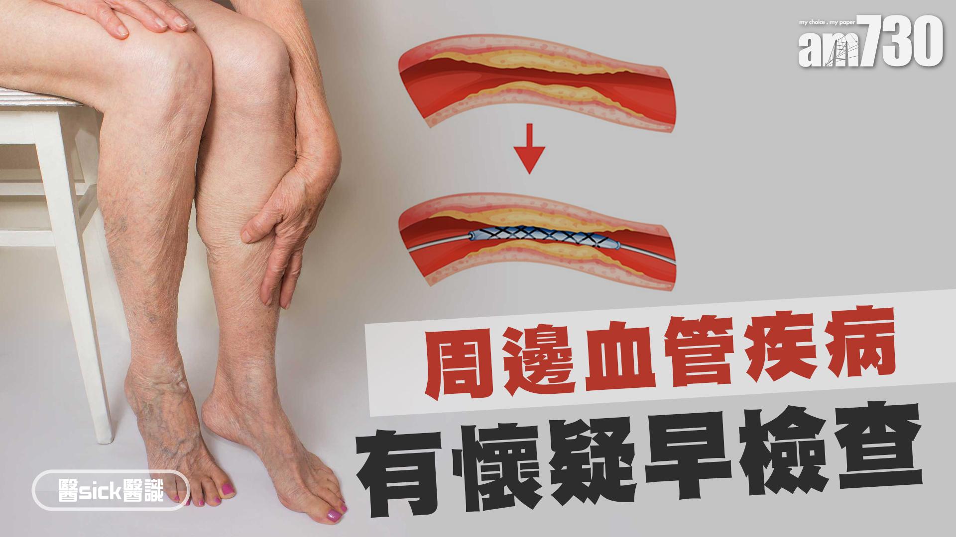 周邊血管疾病 有懷疑早檢查