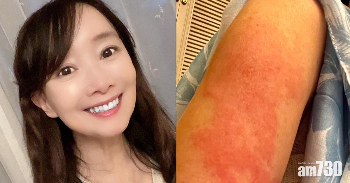 陳美齡接種第二劑疫苗 疑過敏手臂又紅又腫