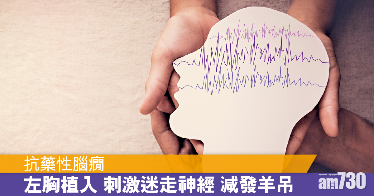 抗藥性腦癇 迷走神經刺激術減發作