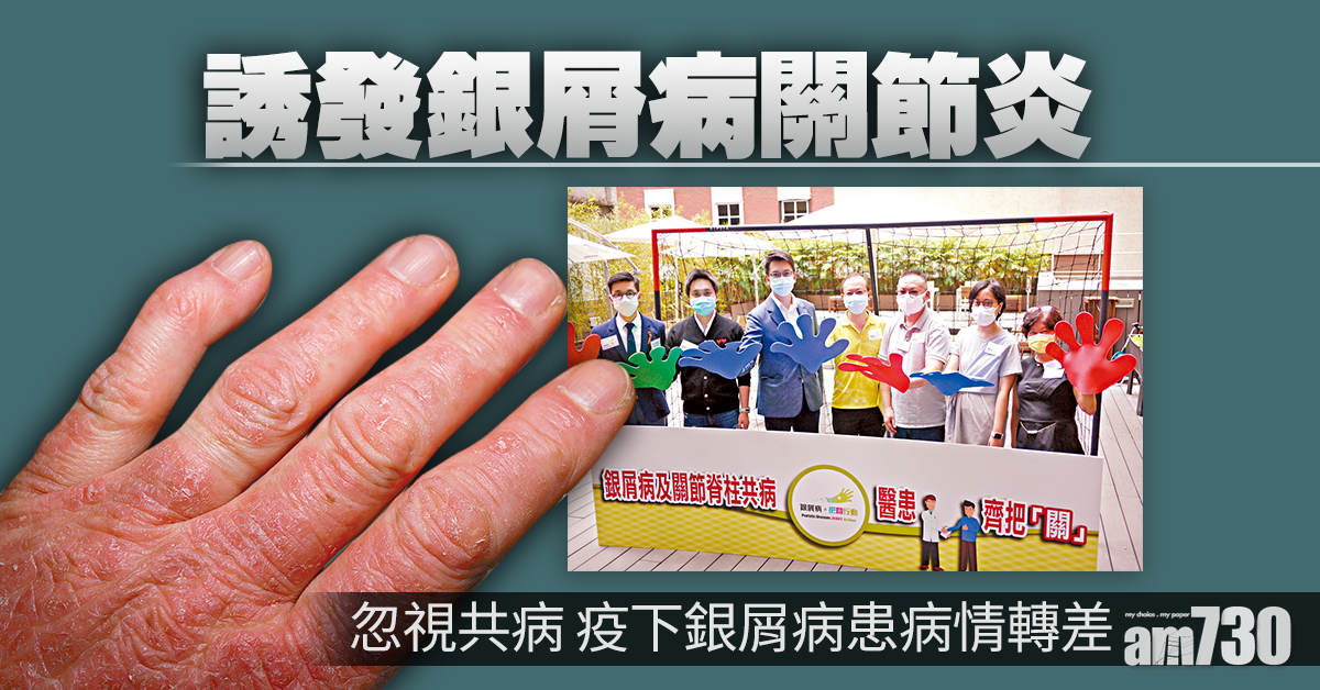 留意銀屑病共病徵狀 避免關節變形