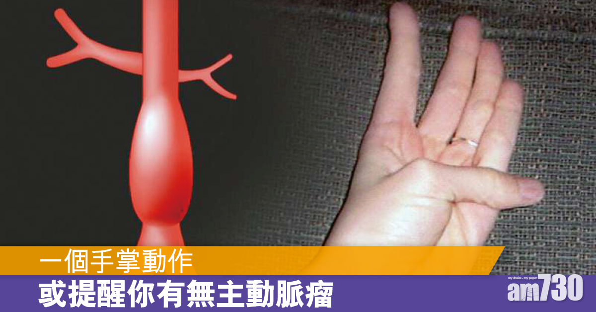 一個動作 或能知道你有無主動脈瘤