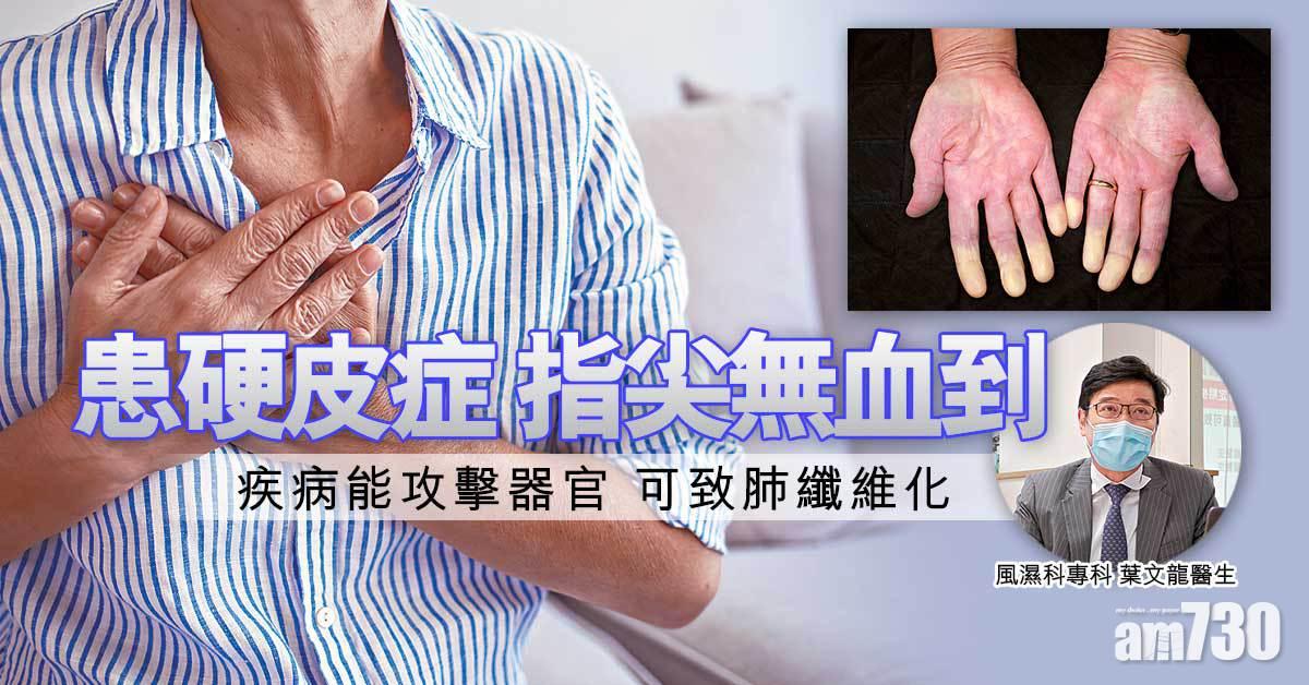 硬皮症肺纖維化 早控病免致呼吸衰竭