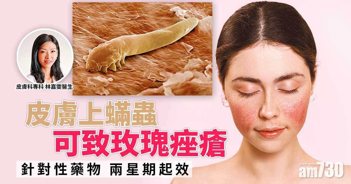 蟎蟲可致玫瑰痤瘡？