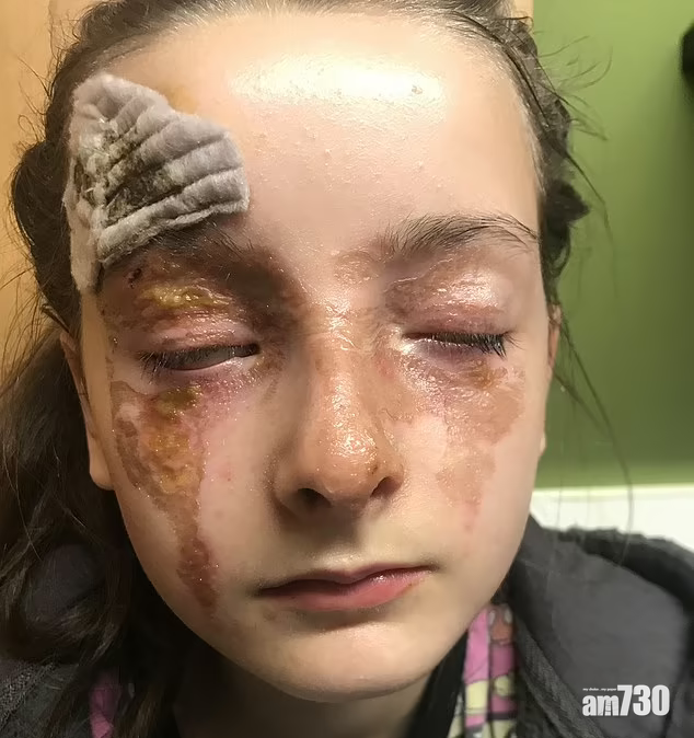 網上謬誤｜不要盡信網上教學  12歲女微波爐整水煮蛋「炸」傷臉差點盲