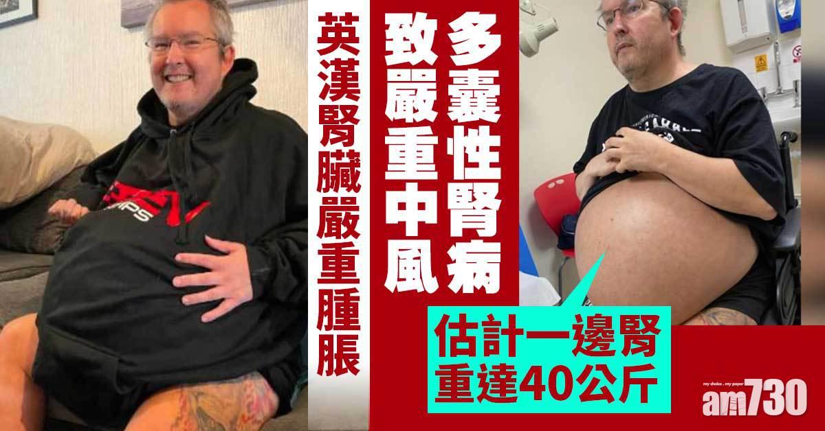奇難雜症｜英漢患病致腎臟嚴重腫脹  估計一邊腎重達40公斤