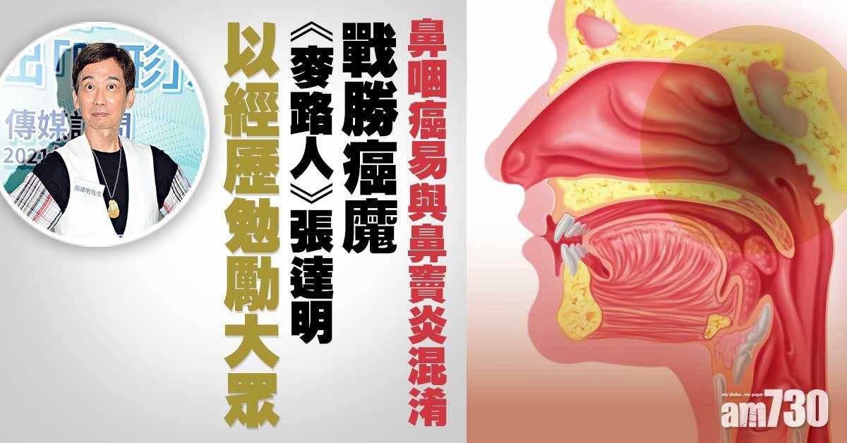 早期鼻咽癌DNA檢測 及早發現提升治愈率