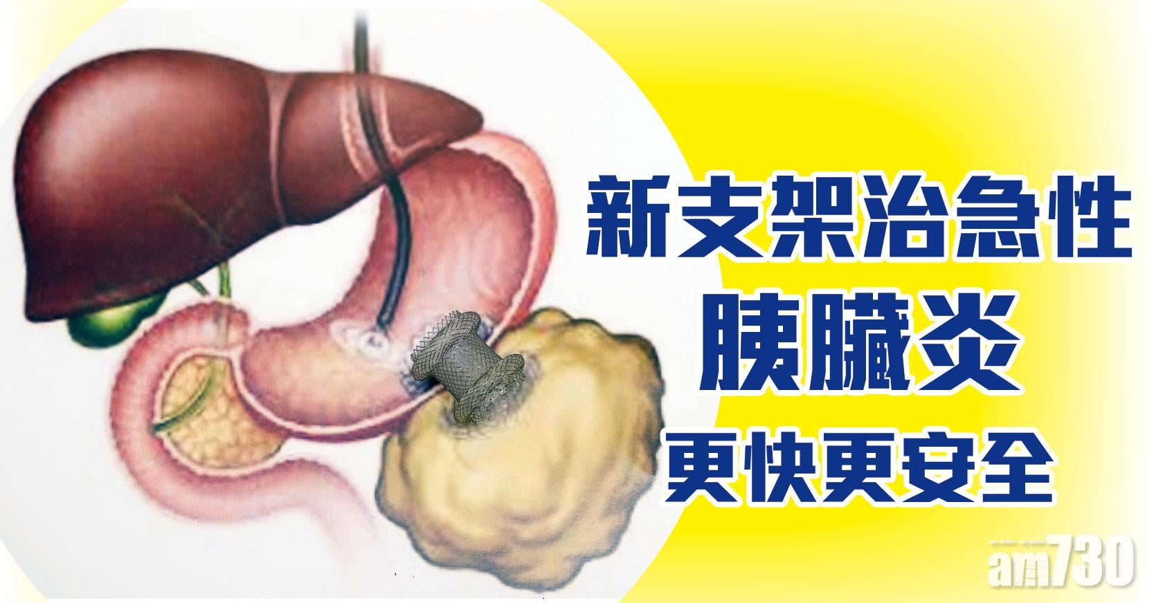 急性胰臟炎 腹痛高燒即求醫  新式支架治療 更快更安全