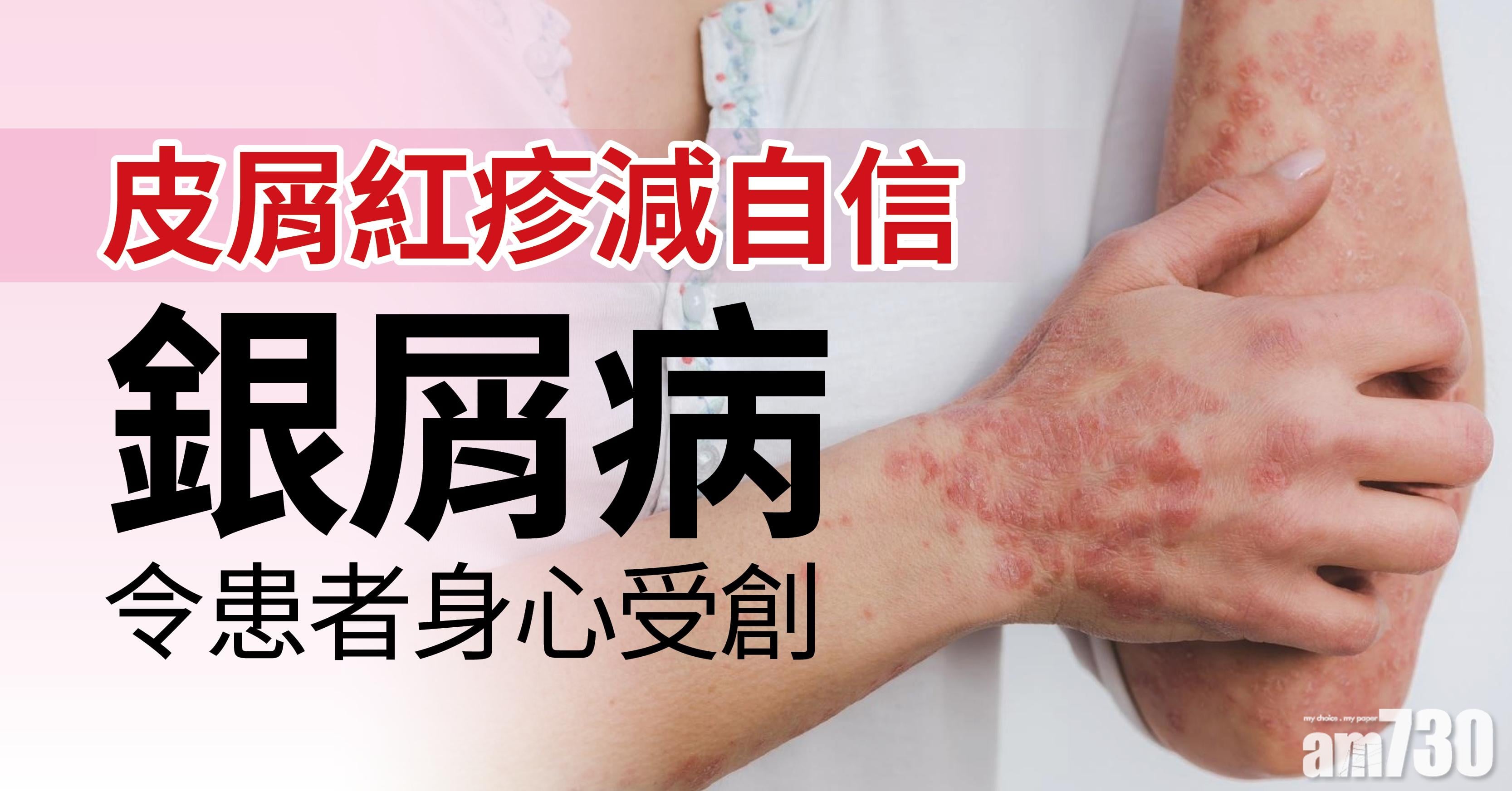 【健康快訊】皮屑紅疹減自信 銀屑病令患者身心受創
