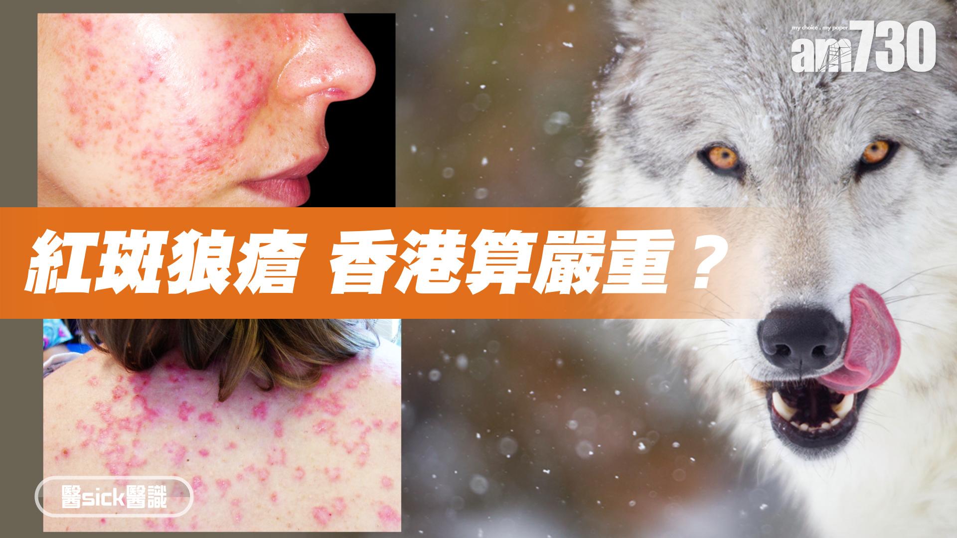 紅斑狼瘡 香港算嚴重？