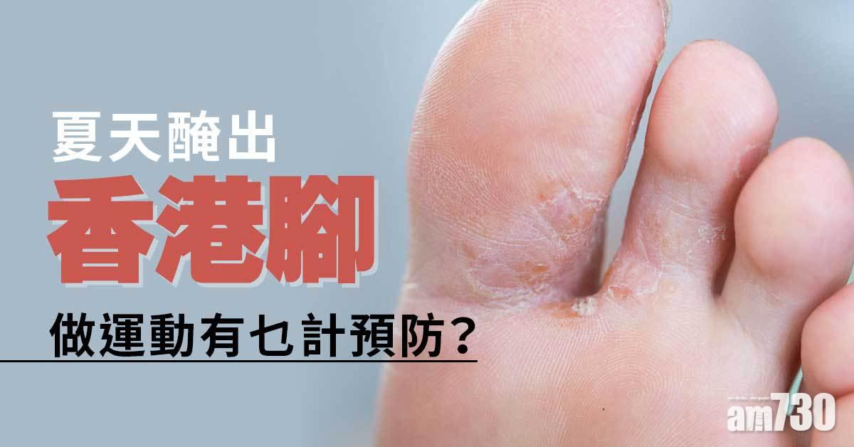 香港腳｜運動人士 4招避開足癬