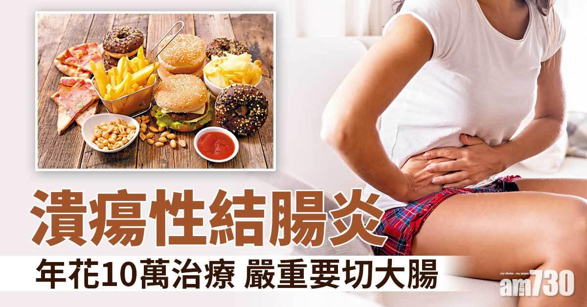 深度緩解潰瘍性結腸炎 避免切腸