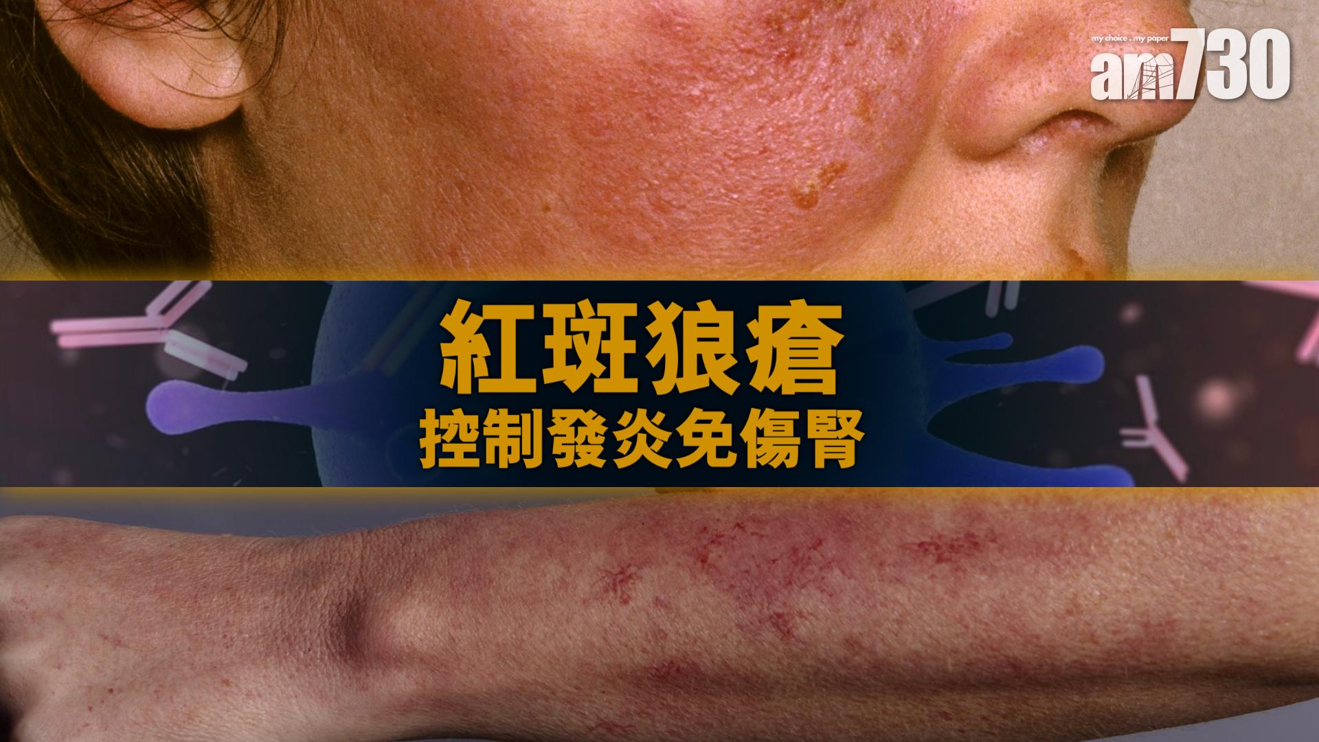 紅斑狼瘡 控制發炎免傷腎