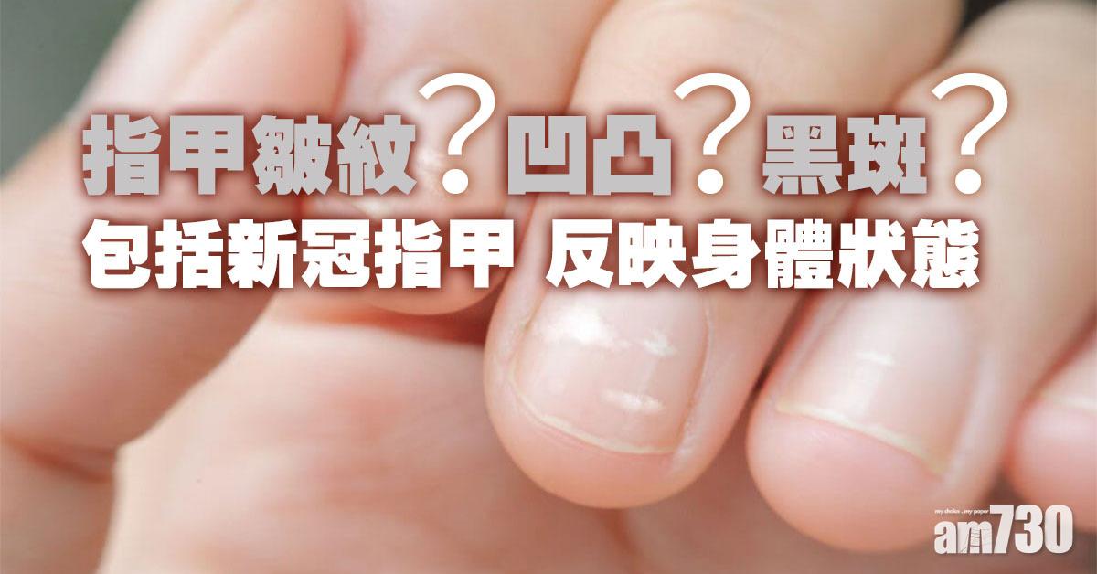 指甲丨表面凹凸不平/直橫紋 仲有「新冠指甲」教你辨識健康 