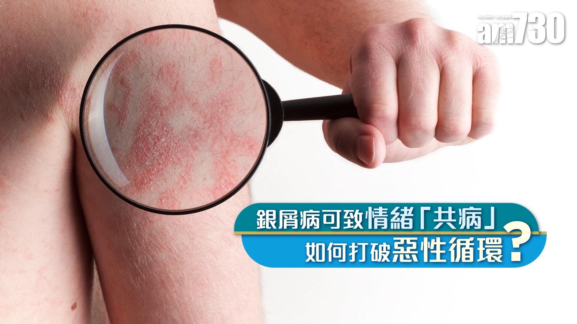 銀屑病可致情緒「共病」 如何打破惡性循環？