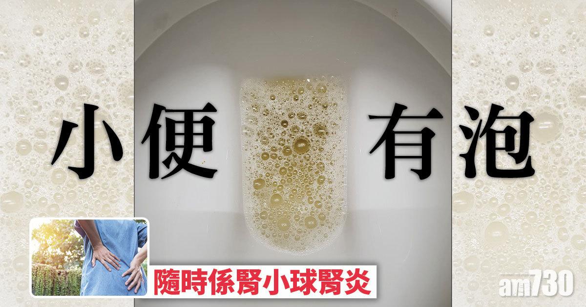 新冠疫苗｜深紅色尿兼有泡 可能中腎小球腎炎