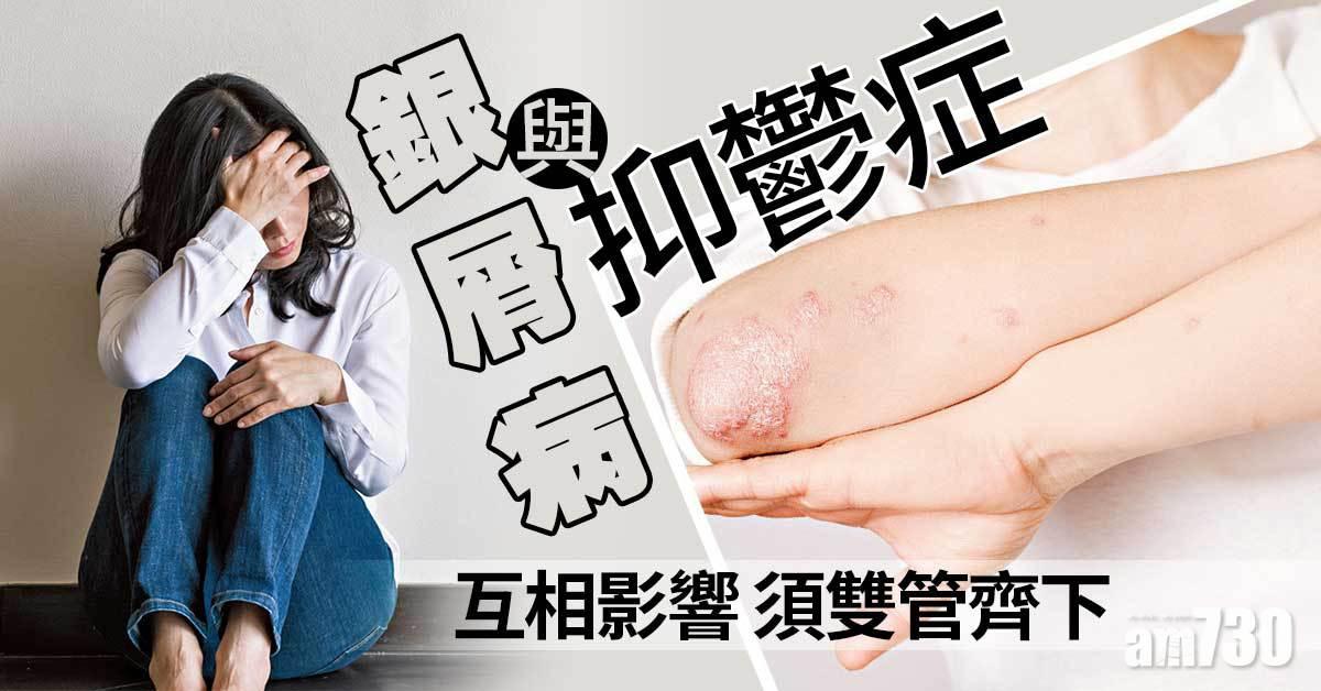 銀屑病可誘發情緒共病
