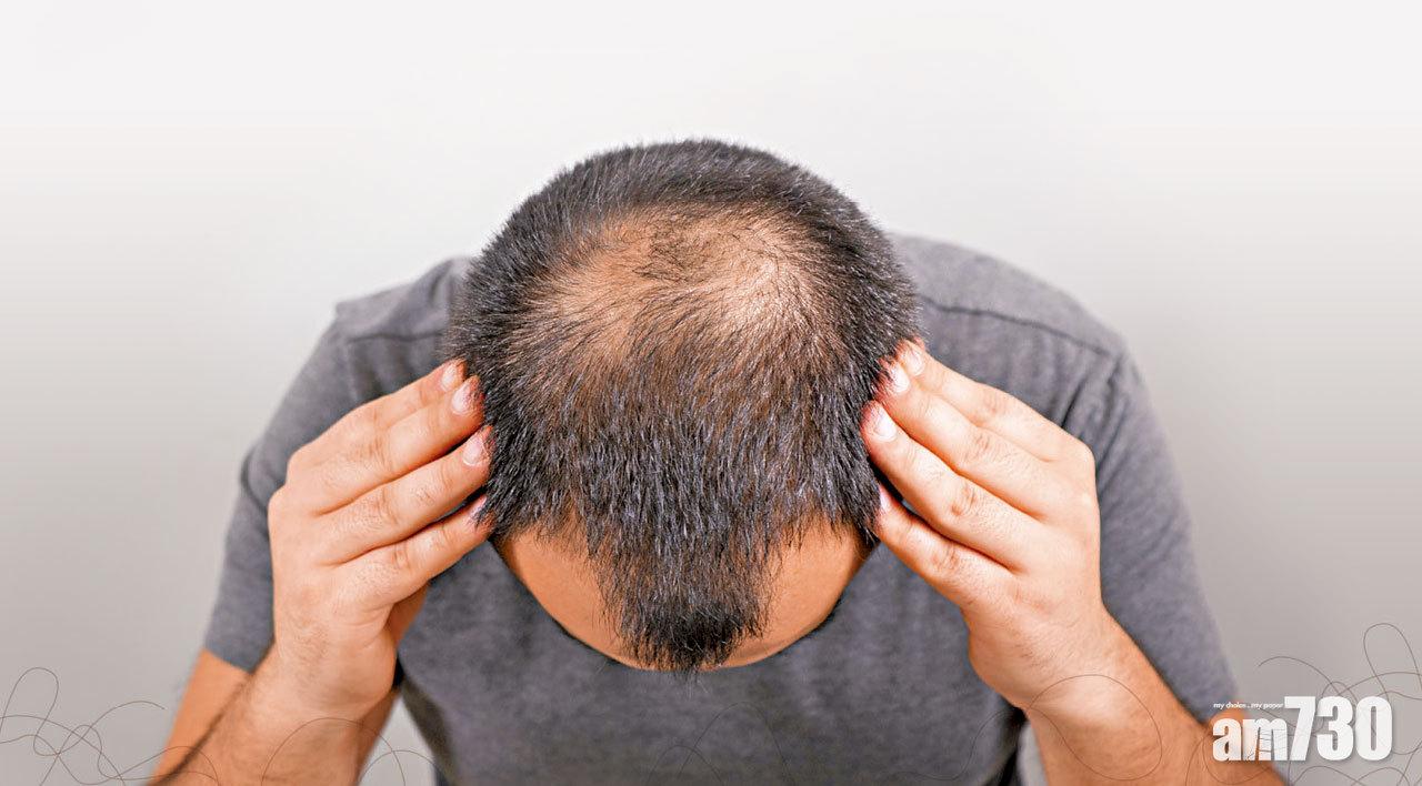 及早處理 脫髮有救