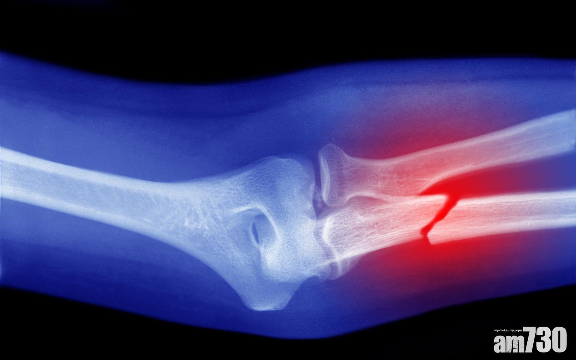 骨折｜港大發現鎂離子免疫調控機制 促進骨骼愈合