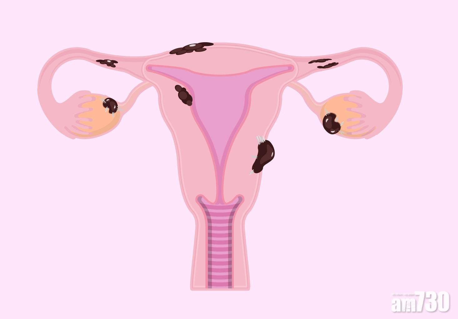 朱古力瘤｜子宮內膜異位 釀不育危機