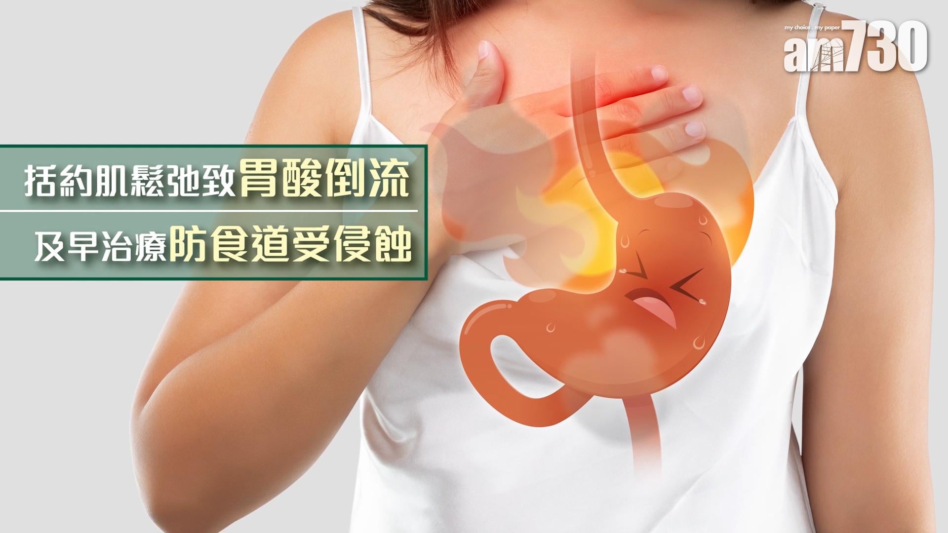 括約肌鬆弛致胃酸倒流 及早治療防食道受侵蝕