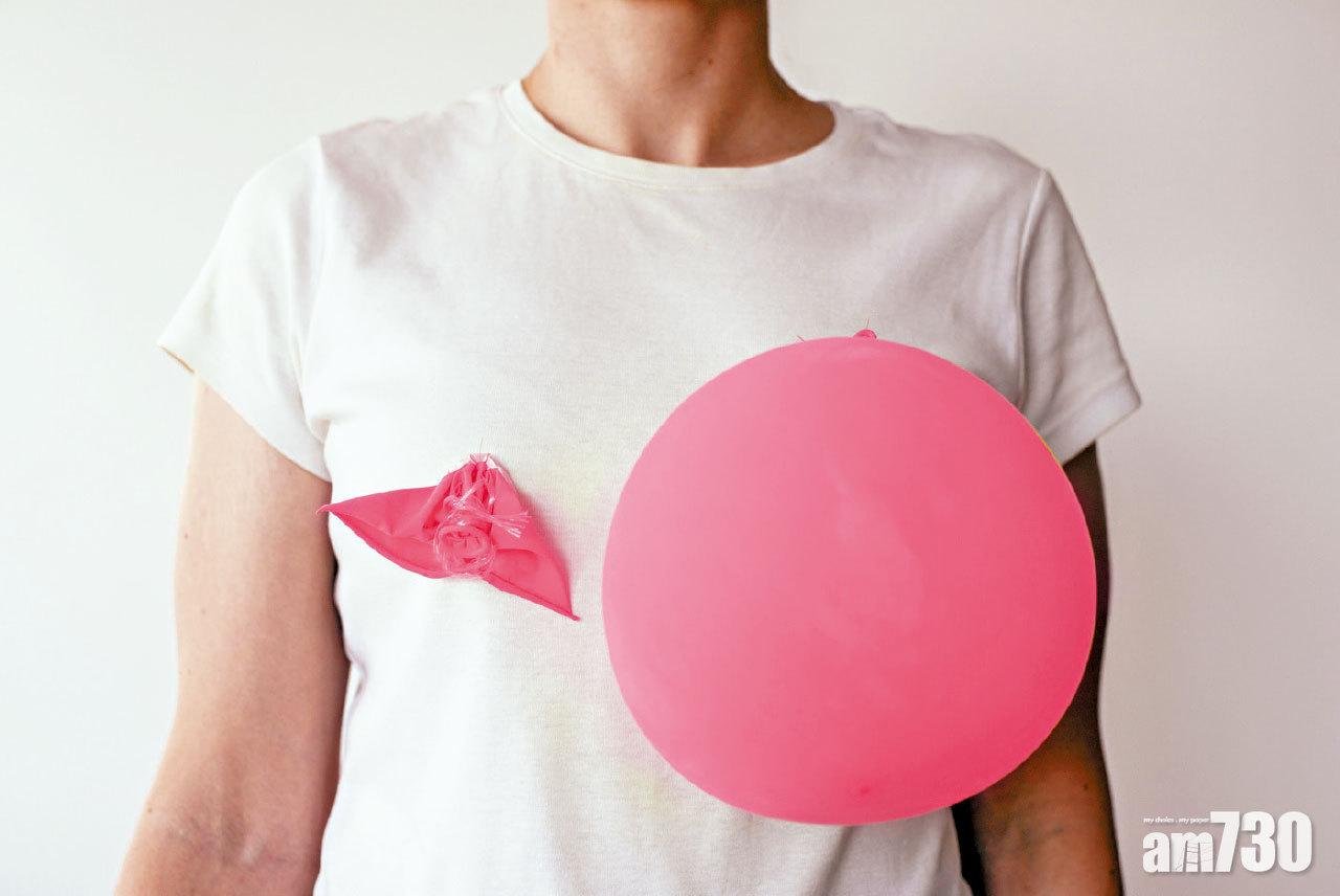 乳房重建 助乳癌患者重拾自信