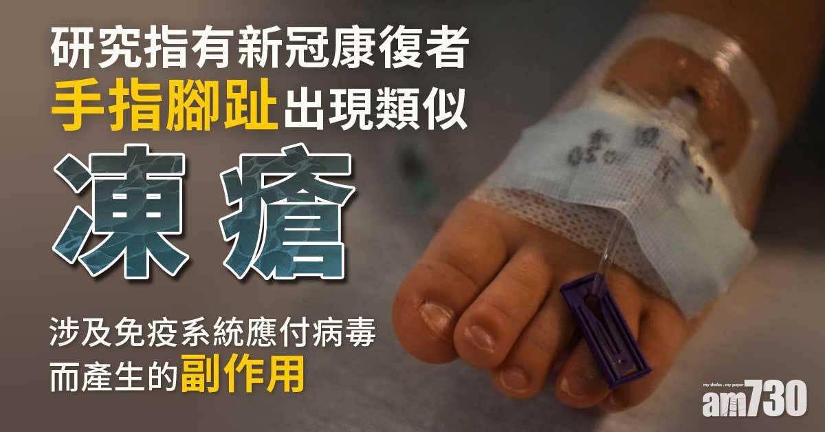 新冠肺炎︱研究指有康復者手指腳趾會出現類似凍瘡