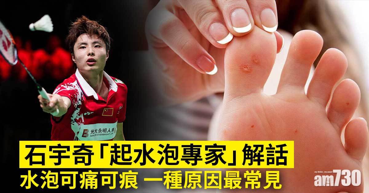 石宇奇以「起水泡專家」為退賽辯解 腳起水泡一種原因最常見