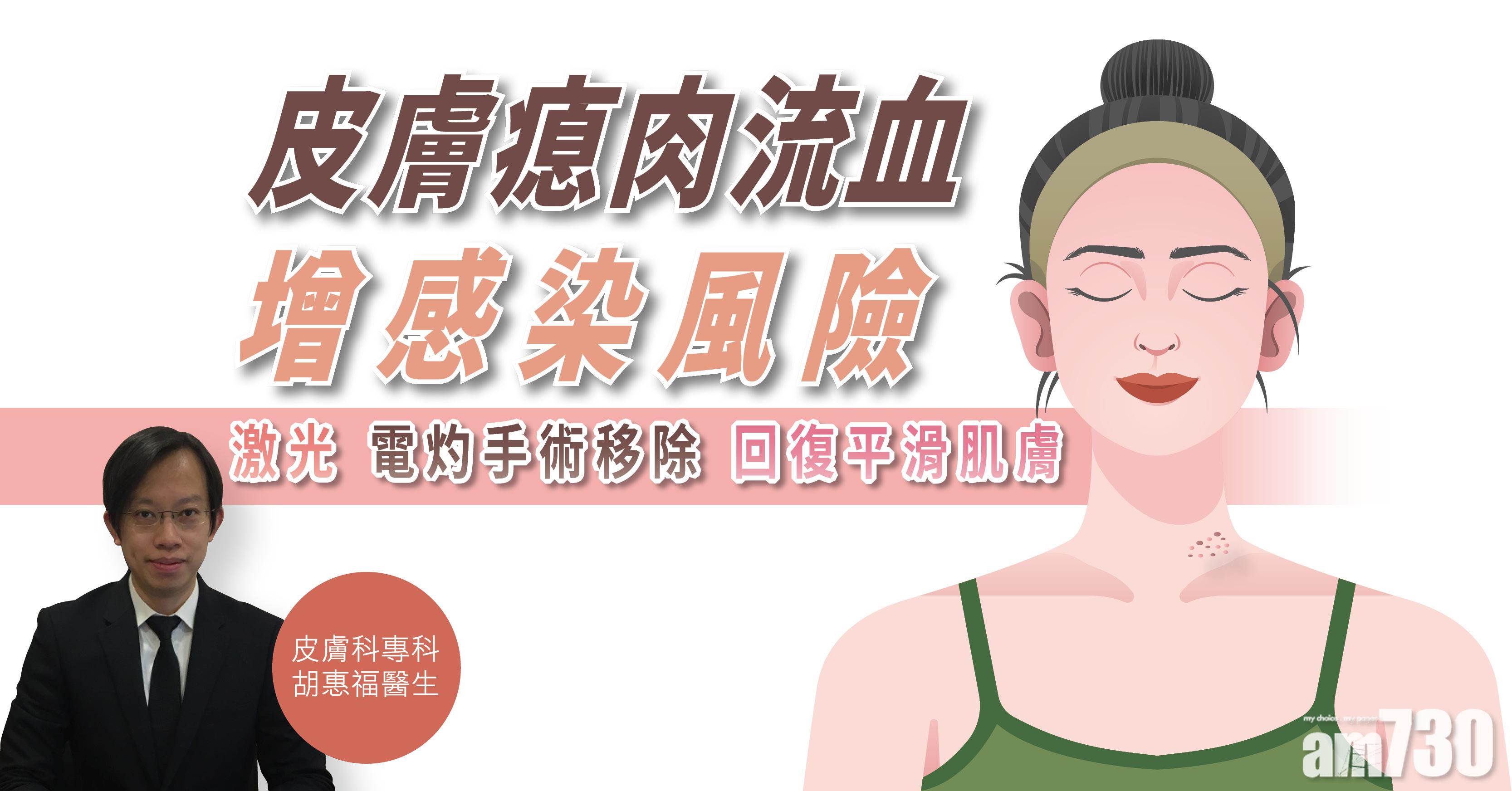 【健康解碼】皮膚瘜肉流血 增感染風險 激光、電灼手術移除 回復平滑肌膚