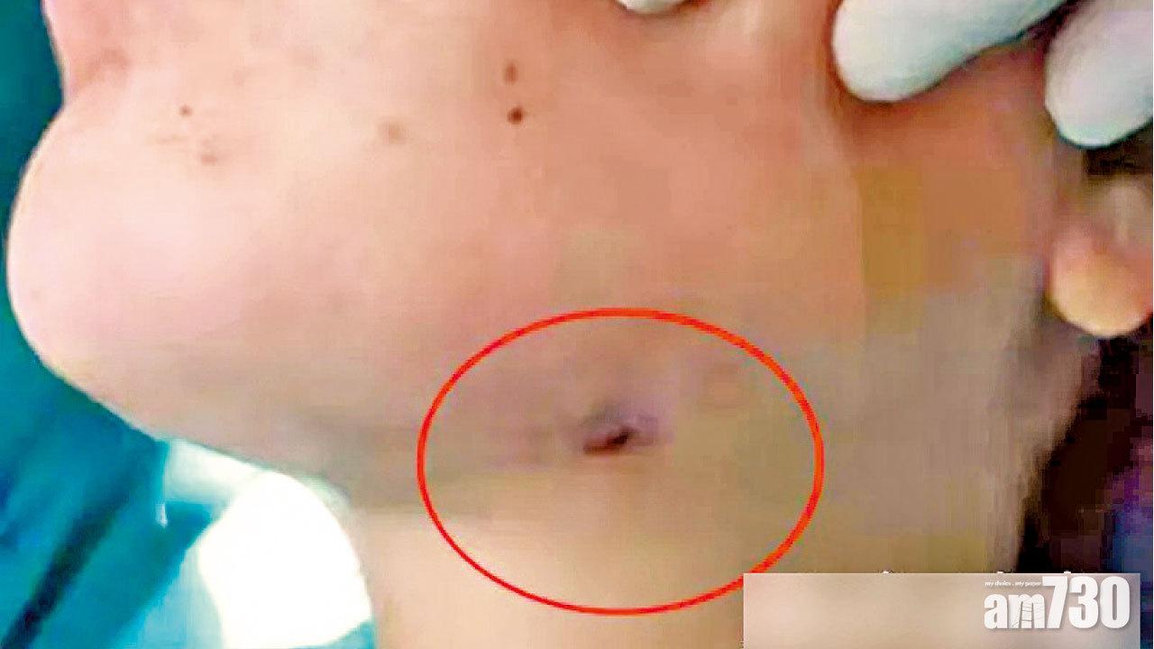 智慧齒發炎幾年死忍 江蘇女臉穿流膿