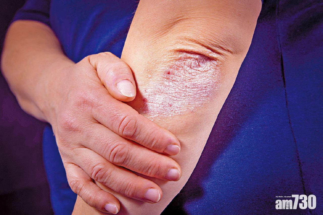 銀屑病不受控 或形成累積生活障礙
