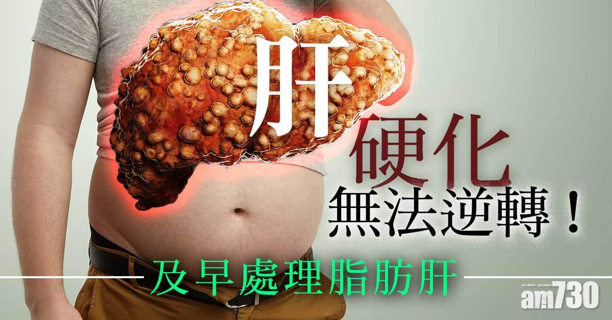 肝硬化｜無法逆轉！及早處理脂肪肝