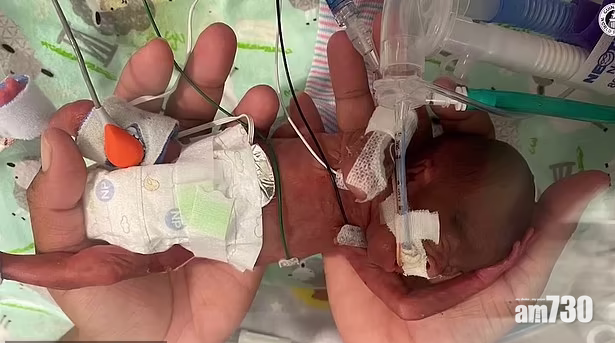 21周出世美國男B首慶祝生日  成全球生存下來最早產嬰 