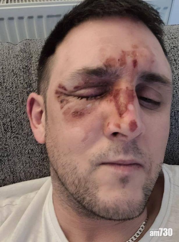 揚言曾「叮蛋1億次」男子微波爐煮蛋遭嚴重灼傷 網民驚訝「乜咁危險」