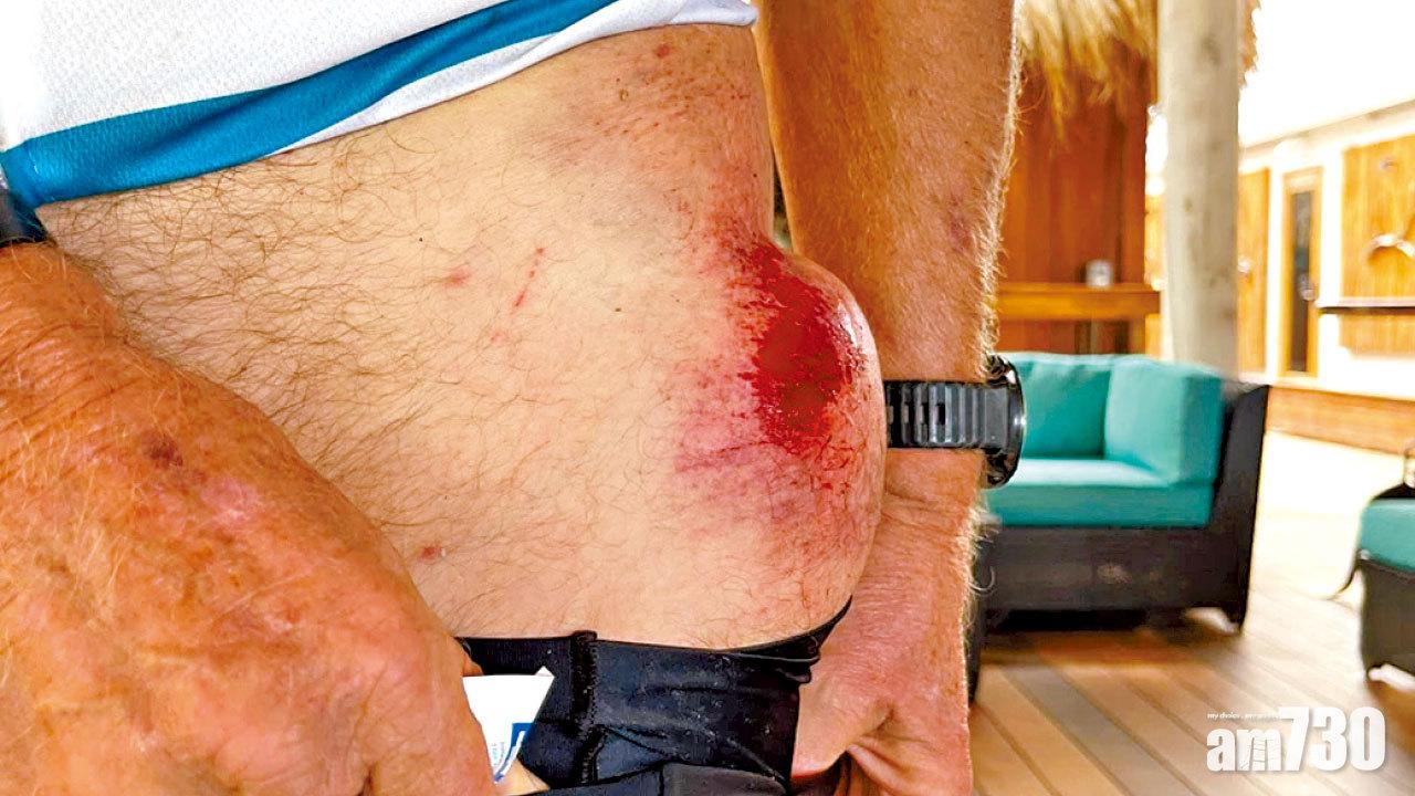 頭盔保命｜盆骨腫起如球 71歲布蘭森炒單車險死