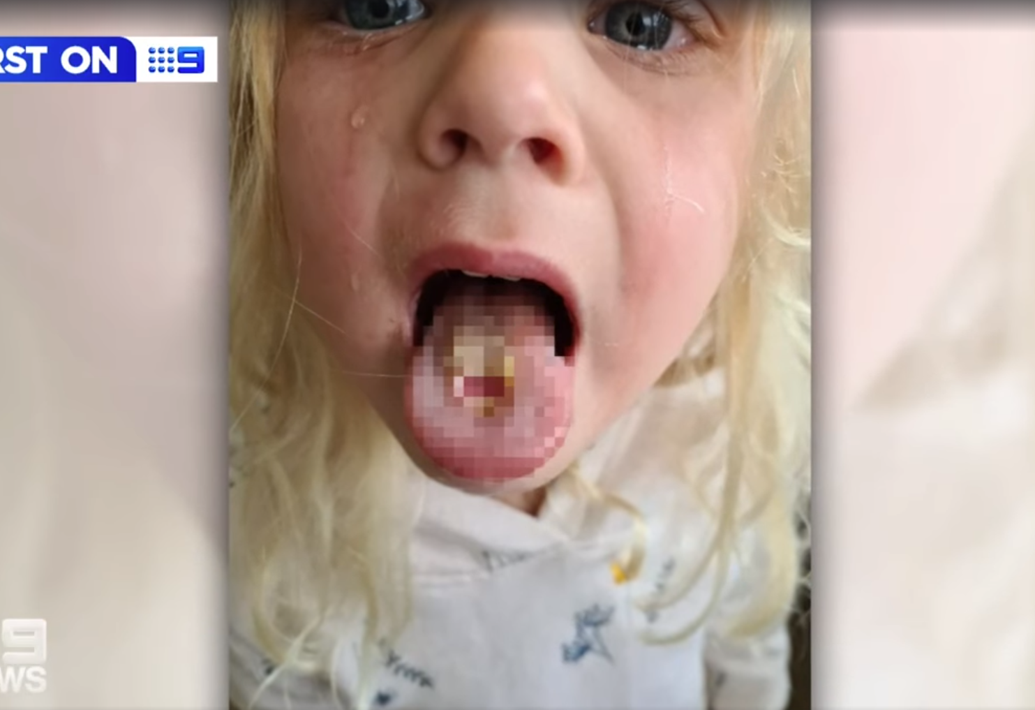 超酸糖｜一次食10粒超酸糖 4歲女脷穿窿 阿媽爆喊(有片)