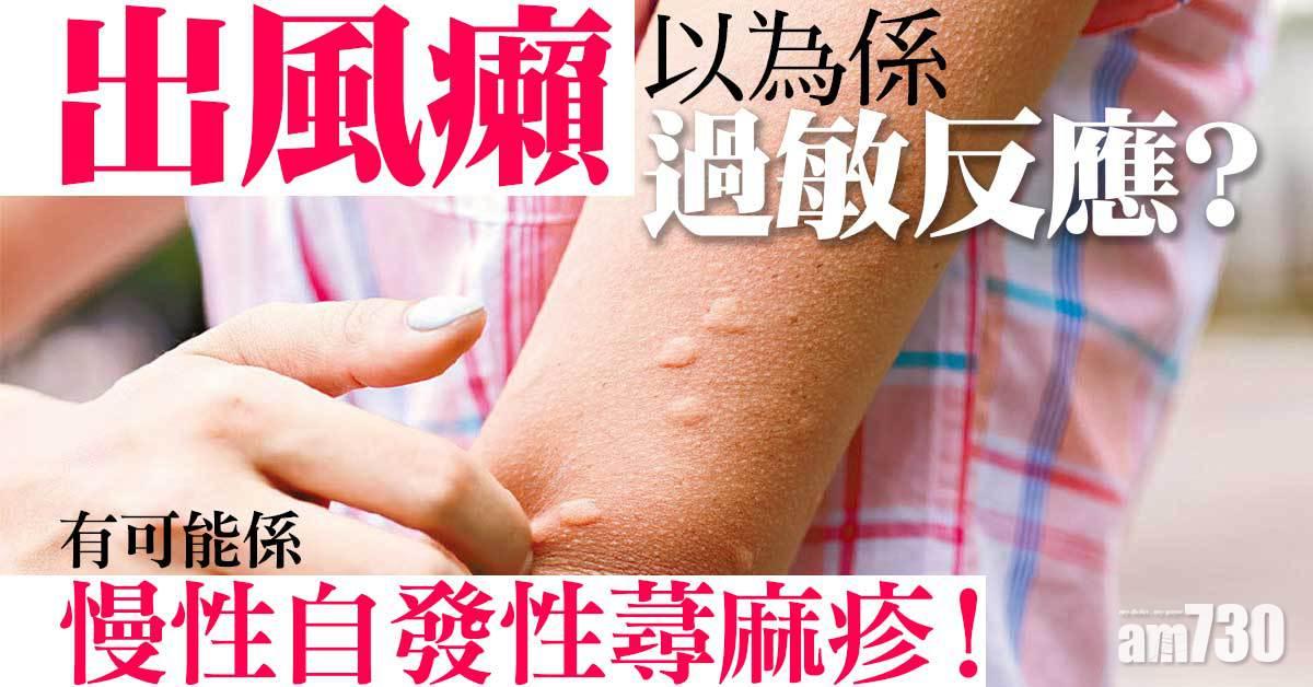 慢性自發性蕁麻疹 易混淆過敏