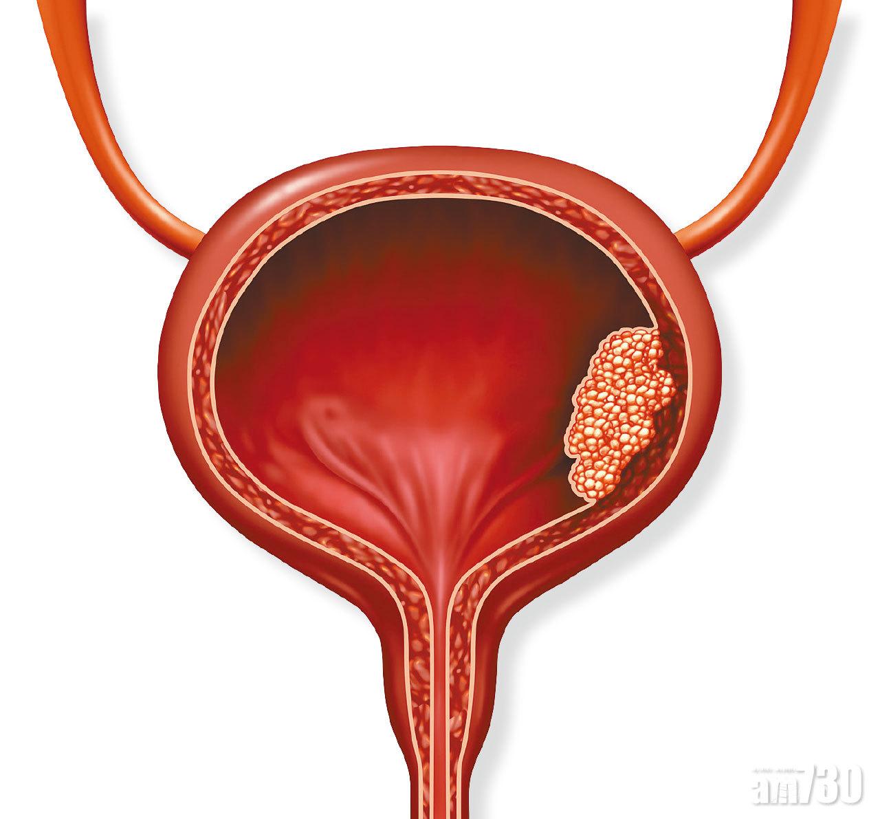 膀胱癌 體內尿路重建減創傷