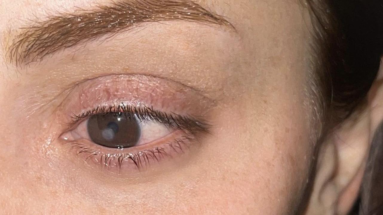 巴西網紅Lilian Melchert戴隱形眼鏡染食肉菌　一度喪失視力