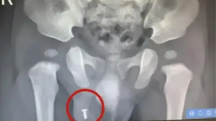 浙江8月大男嬰陰囊內驚現螺絲　醫生推測可能是誤食又疝氣肇禍