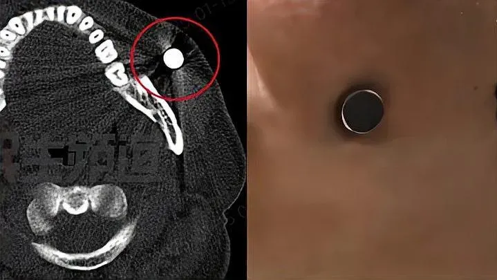 男子面腫4日竟「磁力王上身」吸實磁鐵！醫生驚訝20年來首見